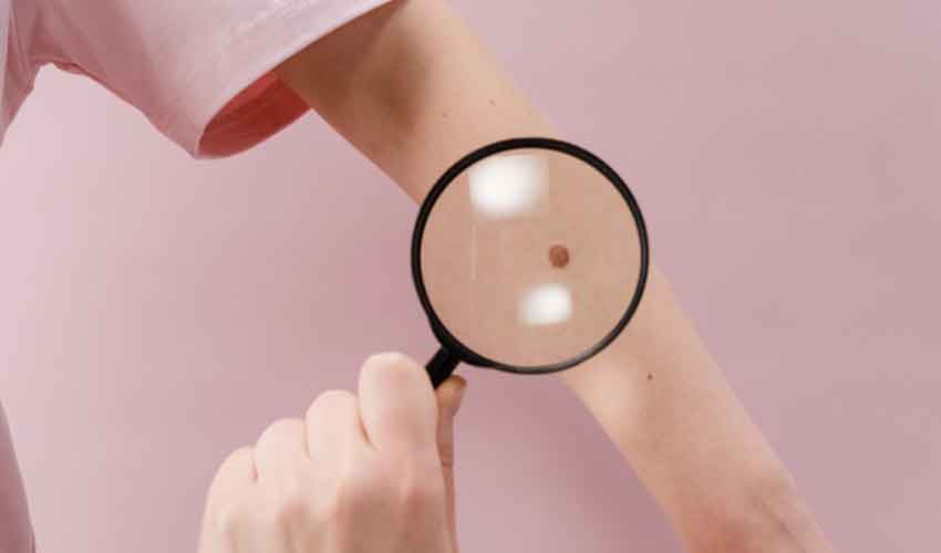 Καρκίνος του Δέρματος: Στάδια, Αίτια, Συμπτώματα και Θεραπεία