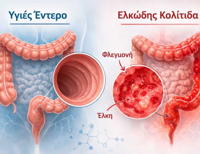 Ελκώδης Κολίτιδα