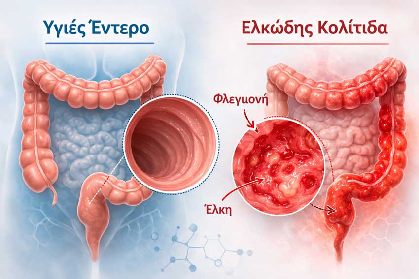 Ελκώδης Κολίτιδα